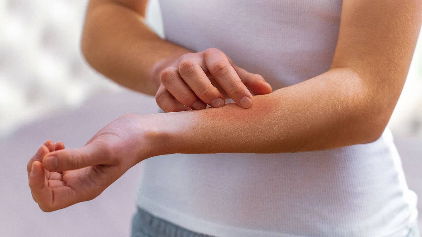 Az allergiák és a kiütések az immunitás csökkenésének gyakori tünetei.